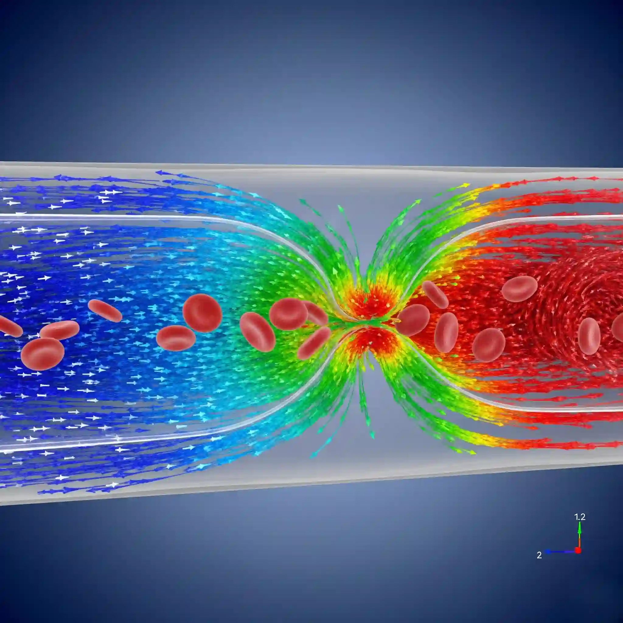 Biomedical CFD simulation of blood flow through a narrowed artery, highlighting areas of high shear stress.